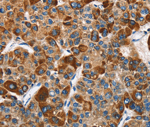 Immunohistochemistry of paraffin-embedded Human liver cancer tissue using SLAMF8 Polyclonal Antibody at dilution 1:40