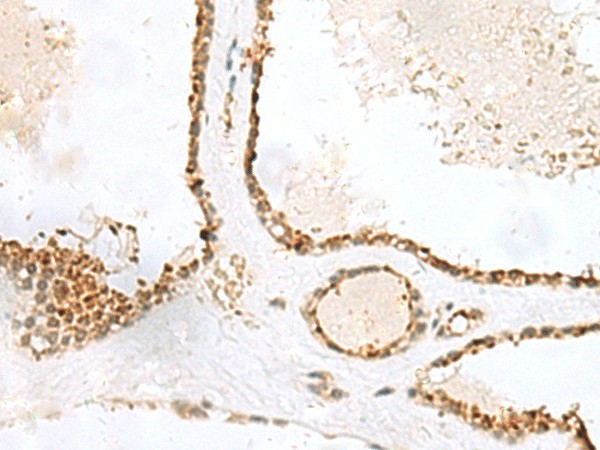 Immunohistochemistry of paraffin-embedded Human thyroid cancer tissue  using LPXN Polyclonal Antibody at dilution of 1:60(?200)