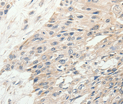 Immunohistochemistry of paraffin-embedded Human esophagus cancer tissue using SLC9A7 Polyclonal Antibody at dilution 1:50