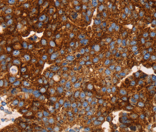 Immunohistochemistry of paraffin-embedded Human breast cancer tissue using EDAR Polyclonal Antibody at dilution 1:45