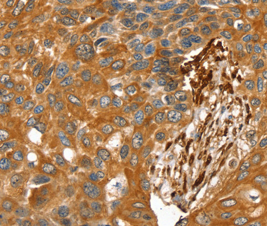 Immunohistochemistry of paraffin-embedded Human esophagus cancer tissue using TAGLN Polyclonal Antibody at dilution 1:30