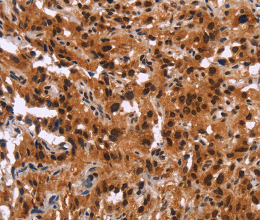 Immunohistochemistry of paraffin-embedded Human thyroid cancer using GPR124 Polyclonal Antibody at dilution of 1:40