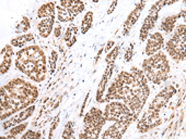 Immunohistochemistry of paraffin-embedded Human esophagus cancer tissue  using FOXG1  Polyclonal Antibody at dilution of 1:60(?200)