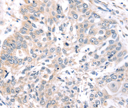 Immunohistochemistry of paraffin-embedded Human lung cancer tissue using ROR1 Polyclonal Antibody at dilution 1:45