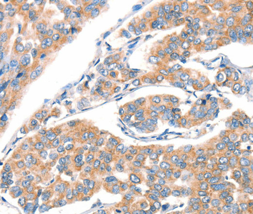 Immunohistochemistry of paraffin-embedded Human breast cancer using CD297 Polyclonal Antibody at dilution of 1:30