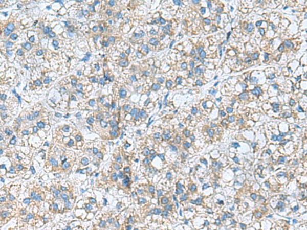 Immunohistochemistry of paraffin-embedded Human liver cancer tissue  using RPL10A Polyclonal Antibody at dilution of 1:50(?200)