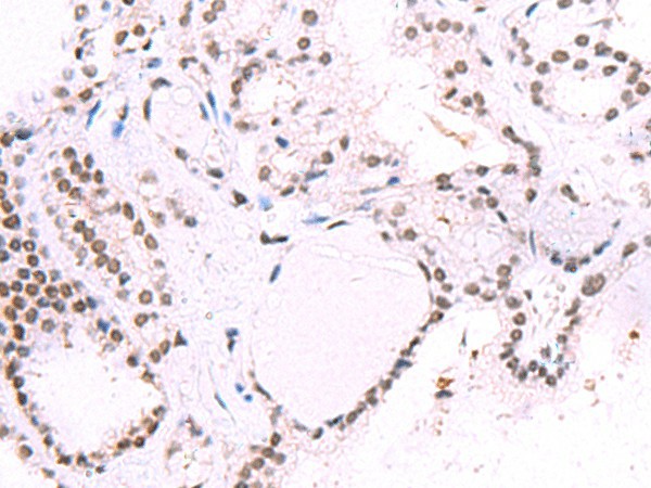 Immunohistochemistry of paraffin-embedded Human thyroid cancer tissue  using IRF2BP1 Polyclonal Antibody at dilution of 1:40(?200)