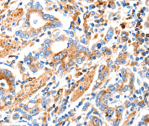 Immunohistochemistry of paraffin-embedded Human gastic cancer using MAP2K2 Polyclonal Antibody at dilution of 1:100