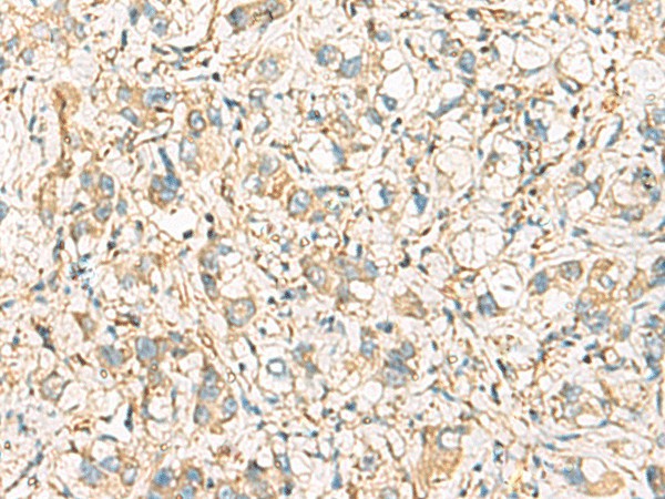 Immunohistochemistry of paraffin-embedded Human liver cancer tissue  using IDS Polyclonal Antibody at dilution of 1:60(?200)