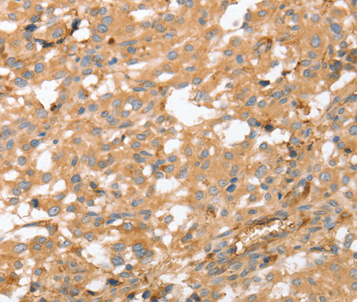 Immunohistochemistry of paraffin-embedded Human thyroid cancer using AHSG Polyclonal Antibody at dilution of 1:60