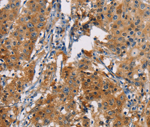 Immunohistochemistry of paraffin-embedded Human gastric cancer tissue using PDCD1LG2 Polyclonal Antibody at dilution 1:50