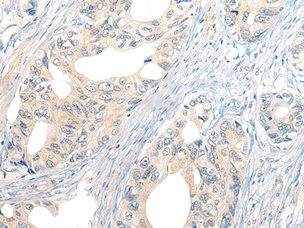 Immunohistochemistry of paraffin-embedded Human gastric cancer tissue  using NOG Polyclonal Antibody at dilution of 1:50(?200)