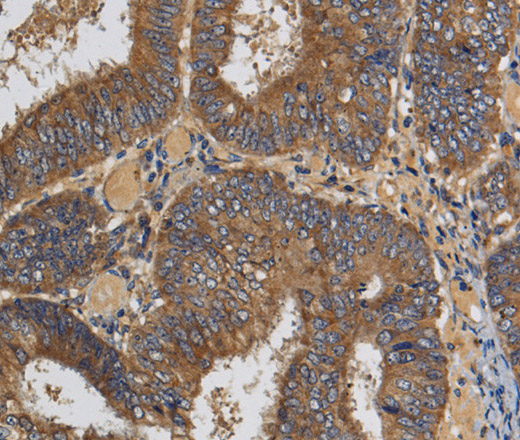 Immunohistochemistry of paraffin-embedded Human colon cancer using KLK6 Polyclonal Antibody at dilution of 1:60