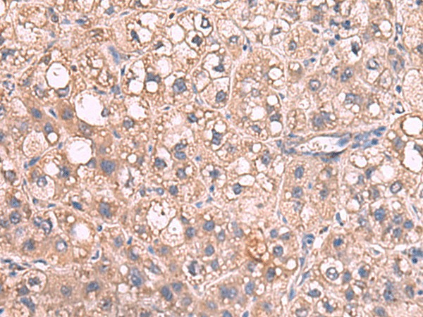 Immunohistochemistry of paraffin-embedded Human liver cancer tissue  using JAZF1 Polyclonal Antibody at dilution of 1:55(?200)