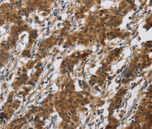 Immunohistochemistry of paraffin-embedded Human gastic cancer using IL17RB Polyclonal Antibody at dilution of 1:40