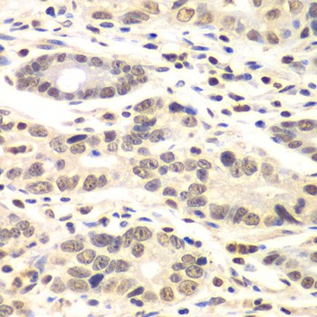 Immunohistochemistry of paraffin-embedded human colon carcinoma using Cyclin C Polyclonal antibody at dilution of 1:100 (40x lens).Perform microwave antigen retrieval with 10 mM PBS buffer pH 7.2 before commencing with IHC staining protocol.