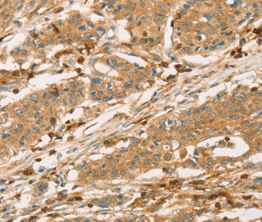 Immunohistochemistry of paraffin-embedded Human gastric cancer tissue using CD43 Polyclonal Antibody at dilution 1:60