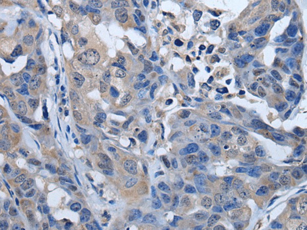 Immunohistochemistry of paraffin-embedded Human breast cancer tissue  using PLK4 Polyclonal Antibody at dilution of 1:50(?200)