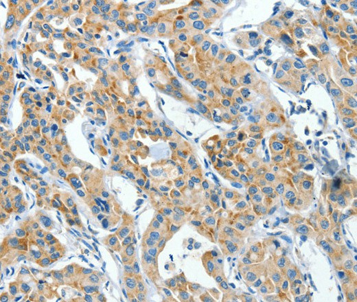 Immunohistochemistry of paraffin-embedded Human lung cancer using CKAP4 Polyclonal Antibody at dilution of 1:30