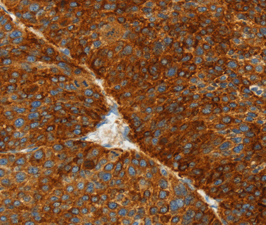 Immunohistochemistry of paraffin-embedded Human liver cancer using ASGR1 Polyclonal Antibody at dilution of 1:50