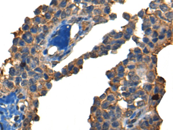 Immunohistochemistry of paraffin-embedded Human ovarian cancer tissue  using DNAJC2 Polyclonal Antibody at dilution of 1:40(?200)