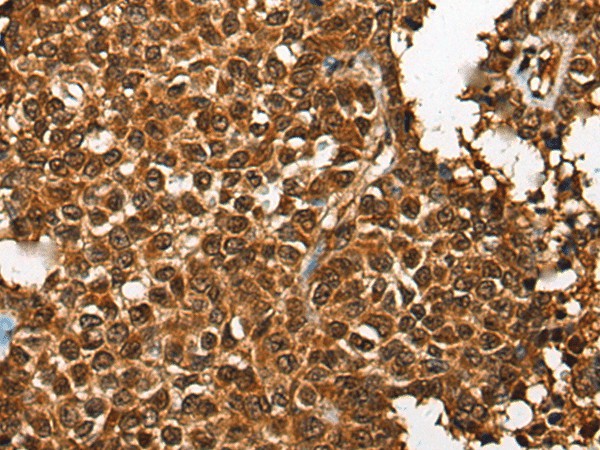 Immunohistochemistry of paraffin-embedded Human ovarian cancer tissue  using CDKL4 Polyclonal Antibody at dilution of 1:35(?200)