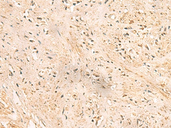 Immunohistochemistry of paraffin-embedded Human prost ate cancer tissue  using SSSCA1 Polyclonal Antibody at dilution of 1:50(?200)