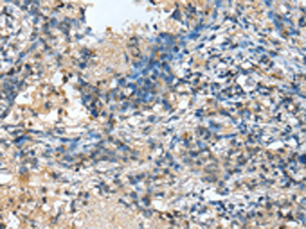 Immunohistochemistry of paraffin-embedded Human lung cancer tissue  using MOB4 Polyclonal Antibody at dilution of 1:25(?200)