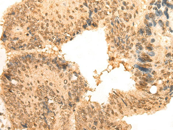 Immunohistochemistry of paraffin-embedded Human colorectal cancer tissue  using CEP57 Polyclonal Antibody at dilution of 1:30(?200)