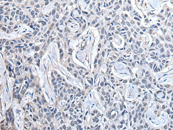 Immunohistochemistry of paraffin-embedded Human lung cancer tissue  using PPIG Polyclonal Antibody at dilution of 1:50(?200)