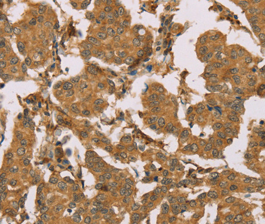 Immunohistochemistry of paraffin-embedded Human thyroid cancer using SUMO2/3/4 Polyclonal Antibody at dilution of 1:100