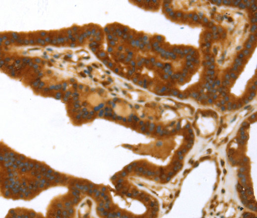 Immunohistochemistry of paraffin-embedded Human thyroid cancer using TP53I11 Polyclonal Antibody at dilution of 1:40