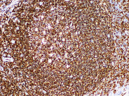 Immunohistochemistry of paraffinembedded Human tonsil tissue with CD45 (LCA) Monoclonal Antibody(Antigen repaired by EDTA).