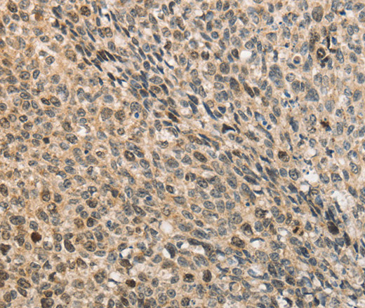 Immunohistochemistry of paraffin-embedded Human lung cancer using CDCA8 Polyclonal Antibody at dilution of 1:40