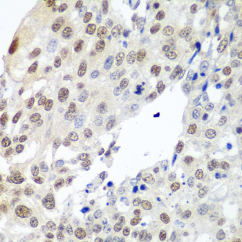 Immunohistochemistry of paraffin-embedded Human lung cancer using PTTG1 Polyclonal Antibody at dilution of  1:100 (40x lens).