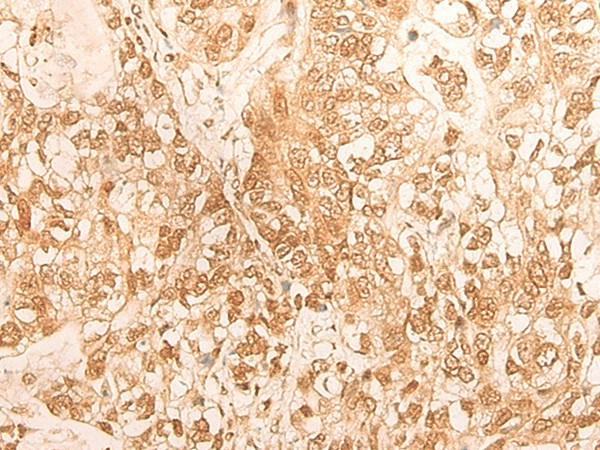 Immunohistochemistry of paraffin-embedded Human gastric cancer tissue  using DBP Polyclonal Antibody at dilution of 1:25(?200)