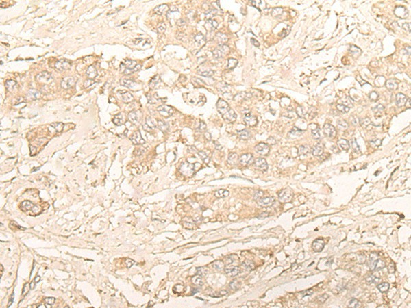 Immunohistochemistry of paraffin-embedded Human liver cancer tissue  using DIMT1 Polyclonal Antibody at dilution of 1:30(?200)