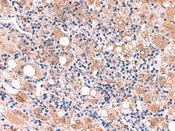 Immunohistochemistry of paraffin-embedded Human liver cancer tissue  using LIPA Polyclonal Antibody at dilution of 1:50(?200)