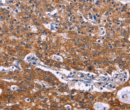 Immunohistochemistry of paraffin-embedded Human gastric cancer tissue using NOS2 Polyclonal Antibody at dilution 1:30