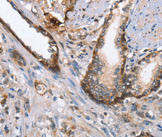 Immunohistochemistry of paraffin-embedded Human prostate cancer using MAD2L1BP Polyclonal Antibody at dilution of 1:65