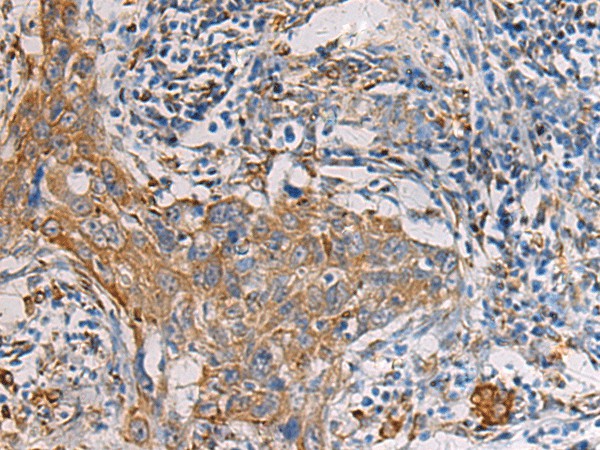 Immunohistochemistry of paraffin-embedded Human esophagus cancer tissue  using PAIP1 Polyclonal Antibody at dilution of 1:60(?200)