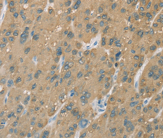 Immunohistochemistry of paraffin-embedded Human liver cancer tissue using CYP2C9 Polyclonal Antibody at dilution 1:50