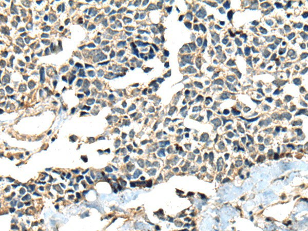 Immunohistochemistry of paraffin-embedded Human lung cancer tissue  using CALHM1 Polyclonal Antibody at dilution of 1:60(?200)