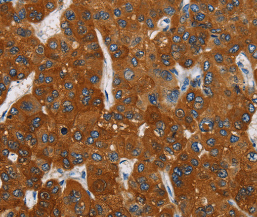 Immunohistochemistry of paraffin-embedded Human liver cancer tissue using CARD9 Polyclonal Antibody at dilution 1:70