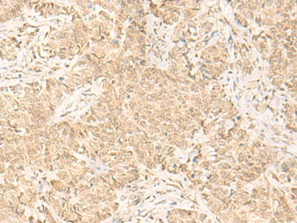 Immunohistochemistry of paraffin-embedded Human ovarian cancer tissue  using IL32 Polyclonal Antibody at dilution of 1:45(?200)