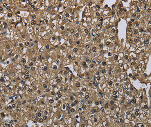 Immunohistochemistry of paraffin-embedded Human prostate cancer using GSTA3 Polyclonal Antibody at dilution of 1:30