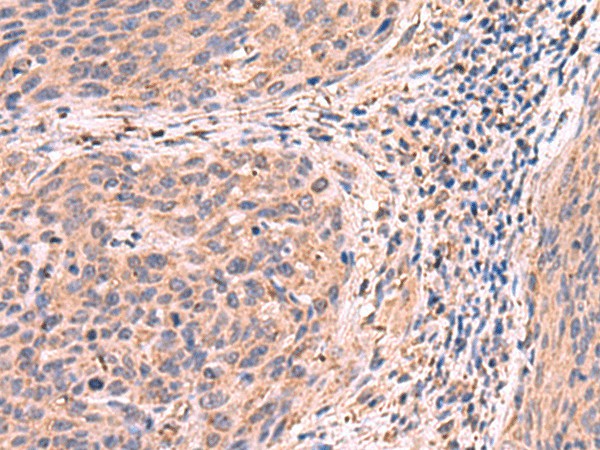 Immunohistochemistry of paraffin-embedded Human cervical cancer tissue  using PER3 Polyclonal Antibody at dilution of 1:55(?200)