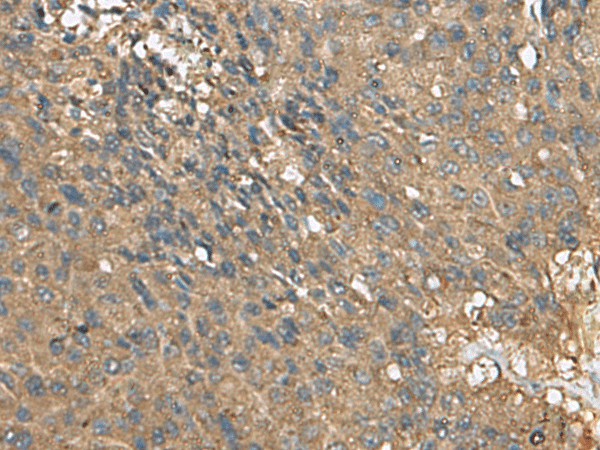 Immunohistochemistry of paraffin-embedded Human liver cancer tissue  using EIF1AX Polyclonal Antibody at dilution of 1:105(?200)