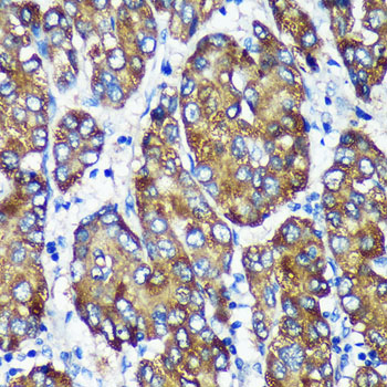 Immunohistochemistry of paraffin-embedded Human liver cancer using [KO Validated] NSDHL Polyclonal Antibody at dilution of 1:100 (40x lens).Perform microwave antigen retrieval with 10 mM PBS buffer pH 7.2 before commencing with IHC staining protocol.