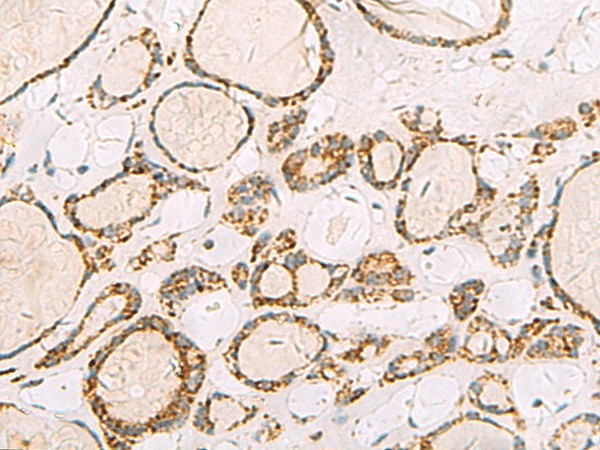 Immunohistochemistry of paraffin-embedded Human thyroid cancer tissue  using ISOC2 Polyclonal Antibody at dilution of 1:95(?200)